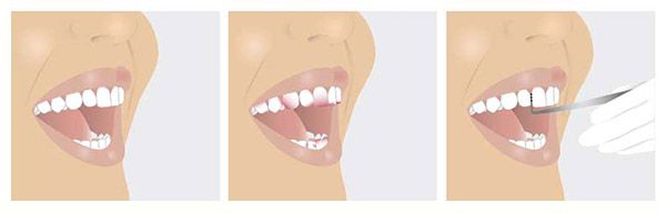 professionellen Zahnreinigung (PZR)
